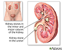 Nephrolithiasis