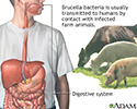 Brucellosis