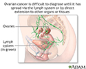 Ovarian cancer dangers