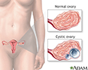 Ovarian cysts