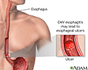 CMV esophagitis