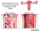 Causes of painful intercourse
