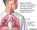 CMV pneumonia