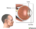 CMV retinitis