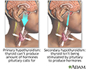 Primary and secondary hypothyroidism