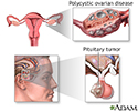 Secondary amenorrhea
