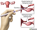 Tubal ligation