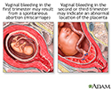 Vaginal bleeding during pregnancy