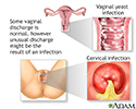 Vaginal discharge