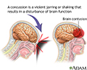 Concussion