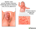 Congenital herpes