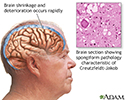 Creutzfeldt-Jakob disease