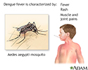 Dengue fever