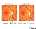 Diabetic retinopathy