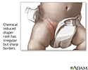 Diaper rash