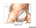 Diaper rash