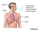 Disseminated coccidioidomycosis