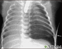 Pneumothorax - chest X-ray