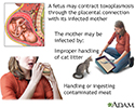 Congenital toxoplasmosis