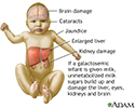 Galactosemia
