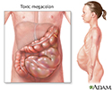 Toxic megacolon