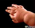 Polydactyly - an infant's hand