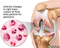 Gonoccocal arthritis