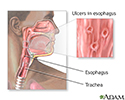 Herpetic esophagitis
