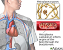 Disseminated histoplasmosis