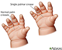 Single palmar crease