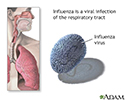 Influenza