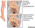 Leg pain (Osgood-Schlatter)