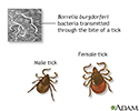Tertiary Lyme disease
