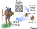 Lyme disease