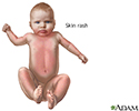 Rubella