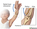 Radial head injury