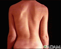 Scoliosis