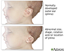 Ear abnormalities