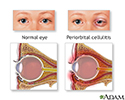Periorbital cellulitis