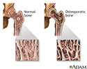 Osteoporosis