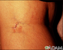 Striae in the popliteal fossa