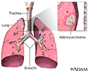 Adenocarcinoma