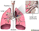 Non-small cell carcinoma