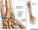 Fractures across a growth plate