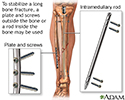Internal fixation devices