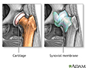 Osteoarthritis vs. rheumatoid arthritis