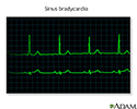 Bradycardia