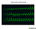 Ventricular tachycardia