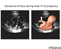 17 week ultrasound