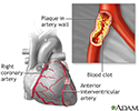 Atherosclerosis